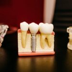 השתלות שיניים ללא כאב